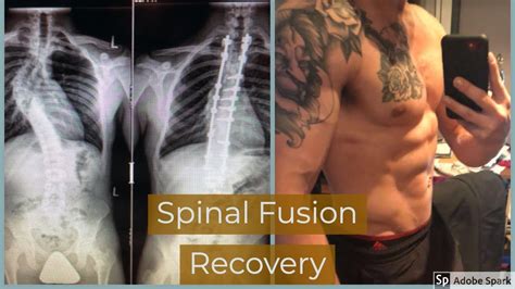 Finding Hope and Healing After Back Fusion: A Guide to Your Recovery Journey
